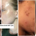 31 Best Skincare Products For People With Adult Acne